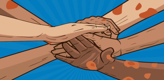 बालबालिकामा कुष्ठरोगको जोखिम बढ्दो: सरकारले उच्च प्राथमिकताका साथ नियन्त्रण गर्ने